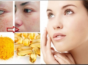 Mách bạn cách trị nám tàn nhang bằng vitamin e siêu hiệu quả, siêu đơn giản
